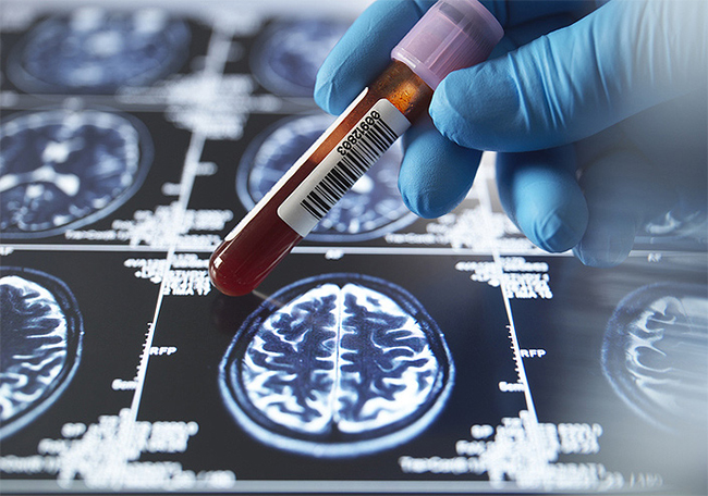 Alzheimer’s Disease – Another Big Pharma Goldmine